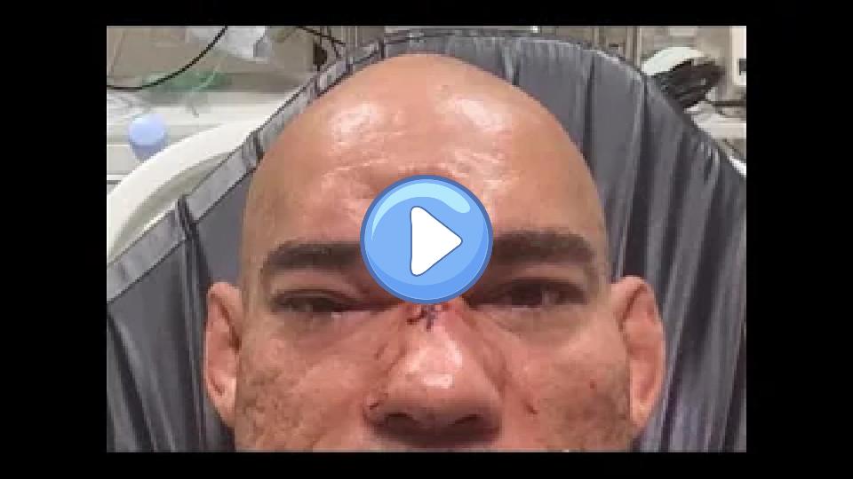 Play video: Cyborg's skull fractured by MVP (Worst MMA injury Joe Rogan has ever seen) Video thumb: Cyborg's skull fractured by MVP (Worst MMA injury Joe Rogan has ever seen)