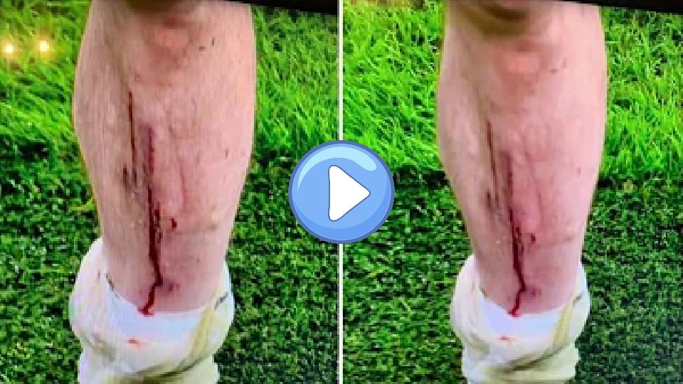 Play video: Warning: Video/picture of Hojbjerg's horrific injury Video thumb: Warning: Video/picture of Hojbjerg's horrific injury