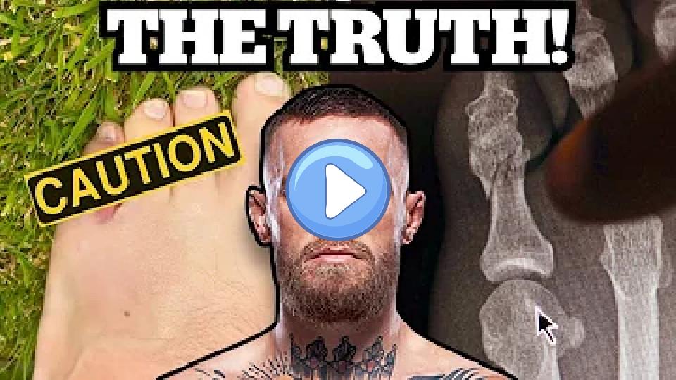 Play video: Conor McGregor Broke His Pinky Toe and Couldn't Fight - Doctor Explains Video thumb: Conor McGregor Broke His Pinky Toe and Couldn't Fight - Doctor Explains
