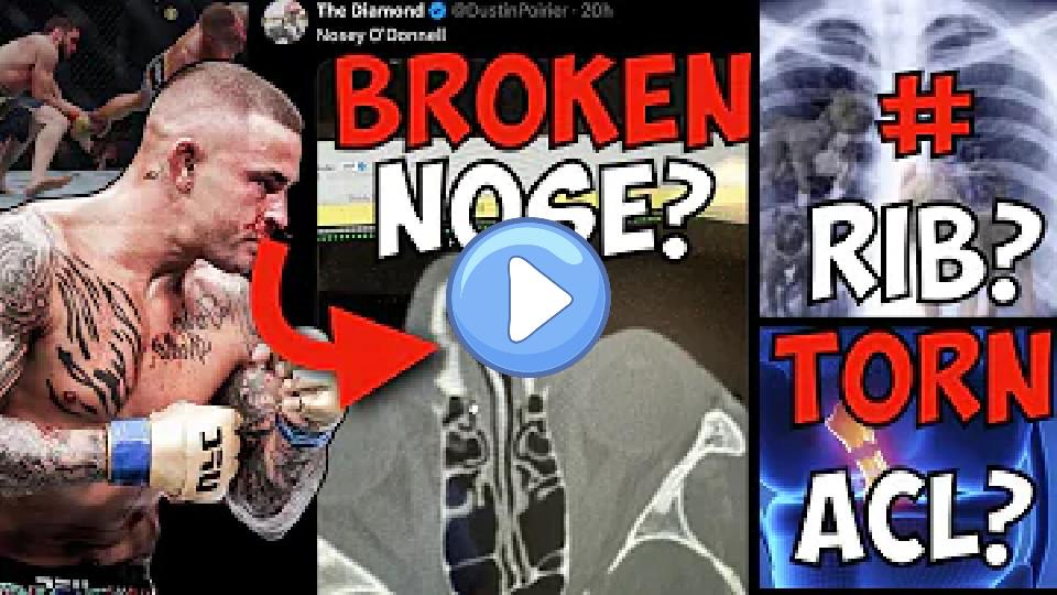 Video thumb: Doctor Explains Dustin Poirier's Multiple Injuries | Post UFC 302: Makhachev vs. Poirier