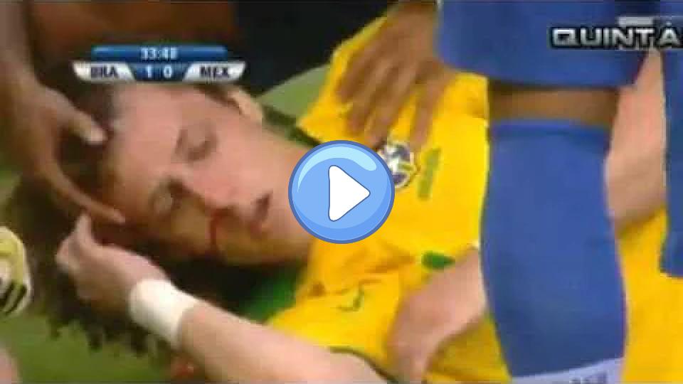 Play video: David Luiz sustained a broken nose during the Brazil vs Mexico match in the Confederations Cup 2013. Video thumb: David Luiz sustained a broken nose during the Brazil vs Mexico match in the Confederations Cup 2013.
