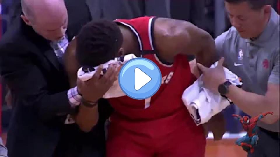 Play video: Kyle Lowry Suffers Severe Facial Injury Video thumb: Kyle Lowry Suffers Severe Facial Injury